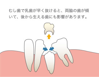 むし歯で乳歯が早く抜けると、両脇の歯が傾いて、後から生える歯にも影響があります。